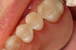 composite fillings smile teeth dentist