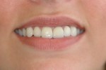 porcelain veneers crown smile teeth