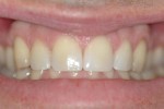 porcelain veneers smile dentist teeth
