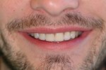 porcelain veneers smile after