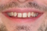 porcelain veneers smile before